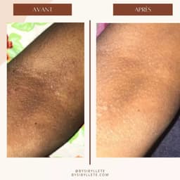Comparatif avant et après l'application du soin By Sibyllete sur une zone irritée, montrant une diminution visible des rougeurs.