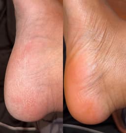 Comparatif avant et après l'application du baume By Sibyllete sur un talon sec, montrant une peau nourrie et lissée.