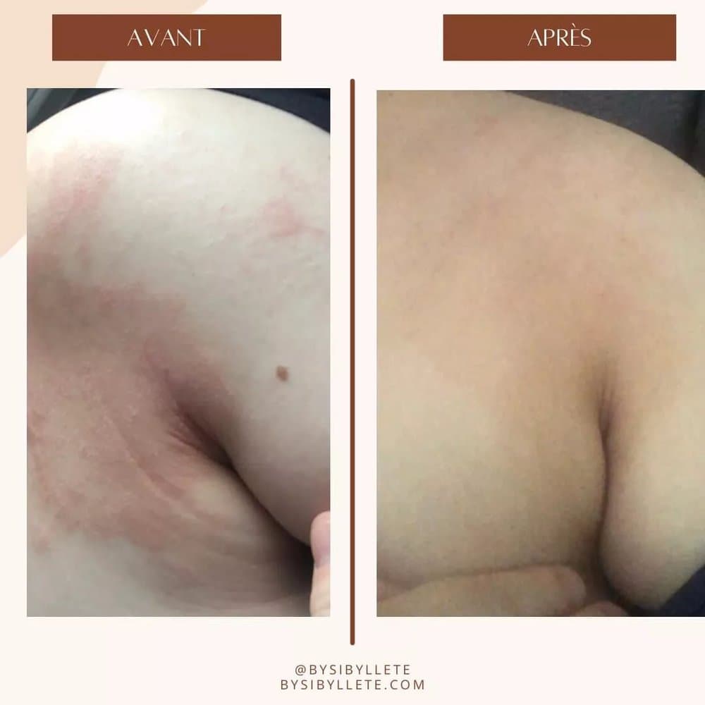 Comparatif avant et après montrant une nette amélioration de la sécheresse cutanée et des squames au niveau du pli du bras.